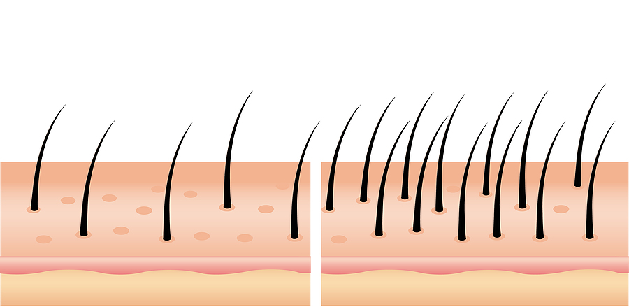 Ab wann sind nach einer Haartransplantation die Grafts fest?