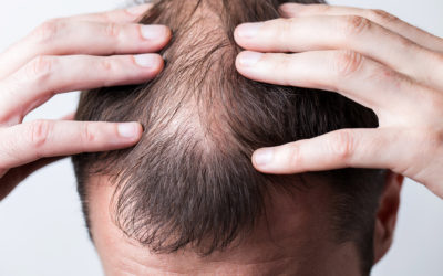 Alopecia congenita – die angeborene Haarlosigkeit