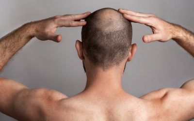 Alopezie – Wenn die Haare ausfallen