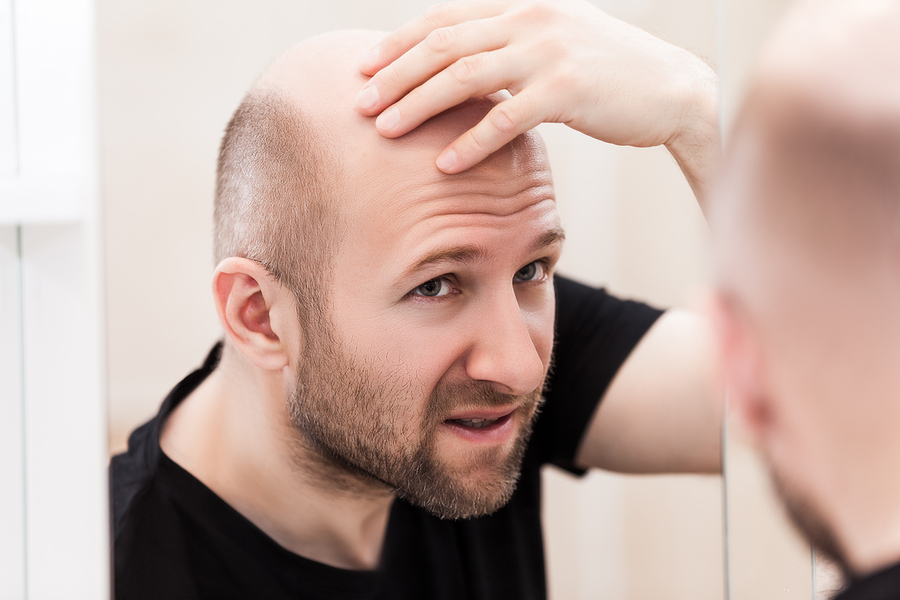 Androgenetische Alopezie