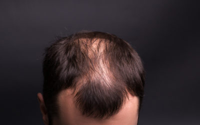 Die verschiedenen Arten von Haarausfall erkennen
