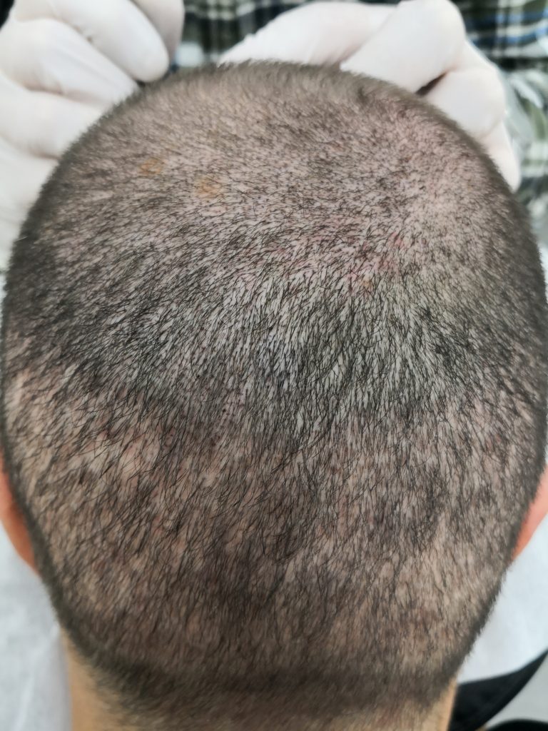 Bei der Haartransplantation in der Türkei war mir das Vorher Nachher Ergebnis sehr wichtig