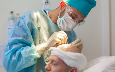 DHI Haartransplantation Methode