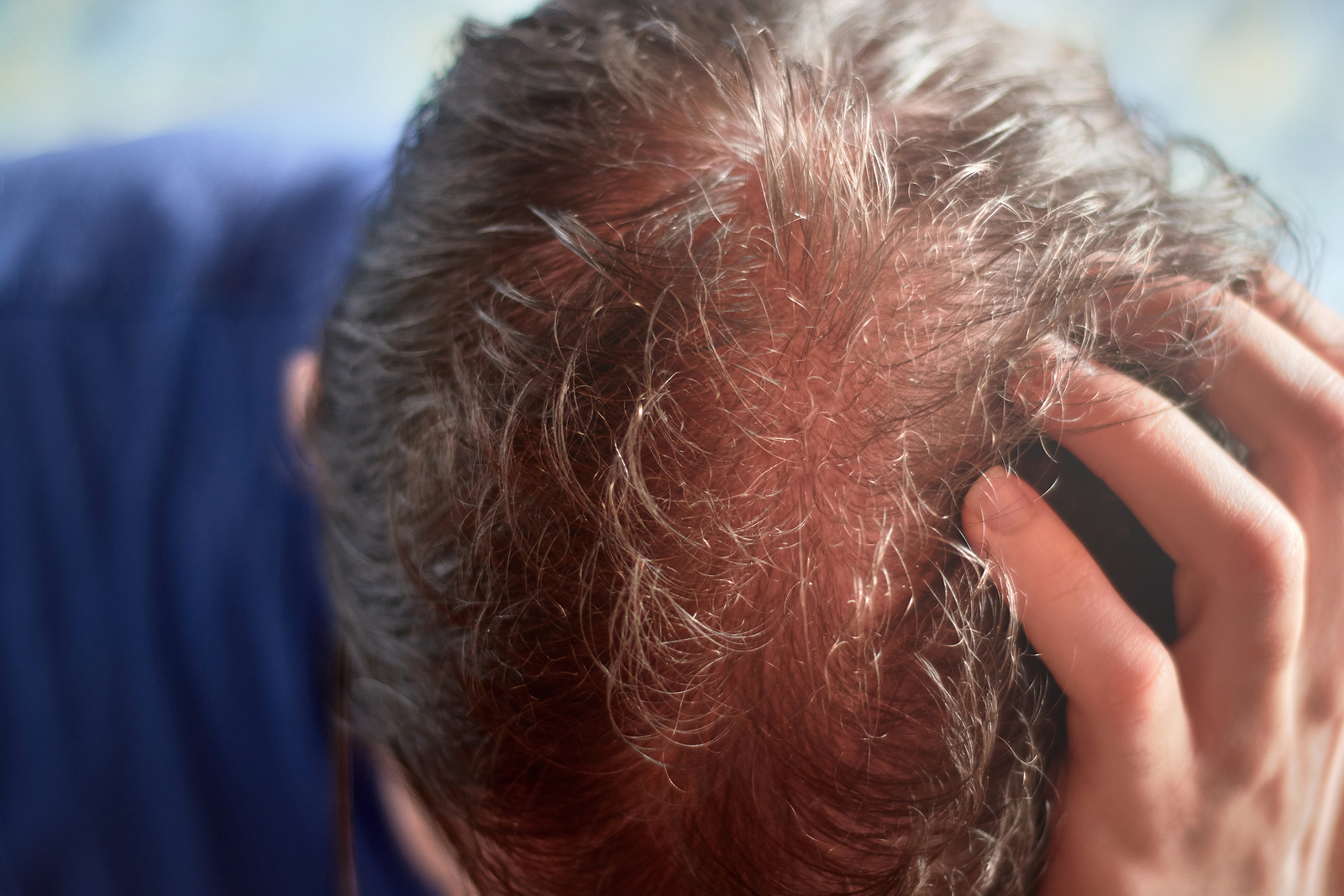 Empfindliche Kopfhaut - Ursachen * Haarausfall Hilfe. 