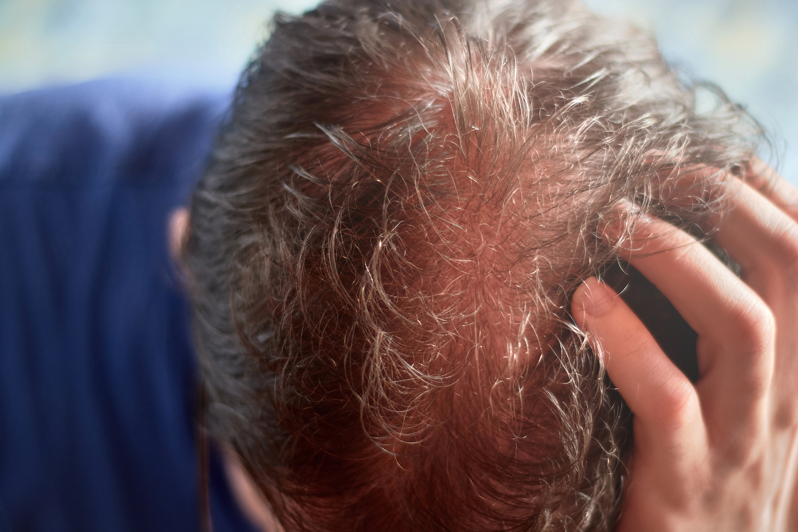 Empfindliche Kopfhaut Ursachen Symptome Das Richtige Shampoo Haarausfall Hilfe