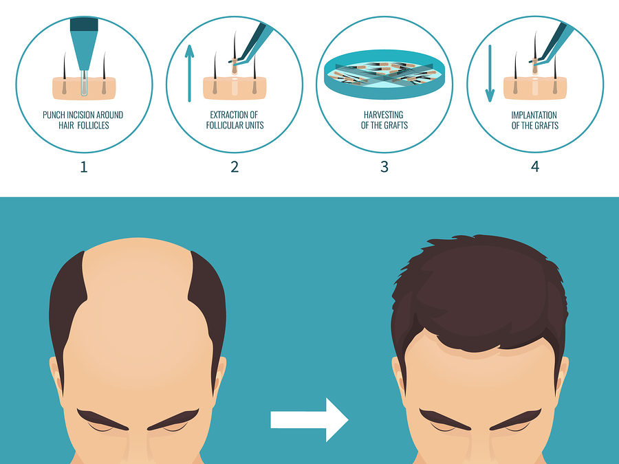 FUE Haartransplantation Methode