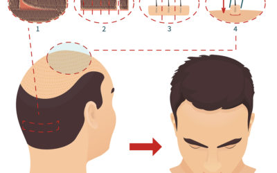 FUT Haartransplantation Methode