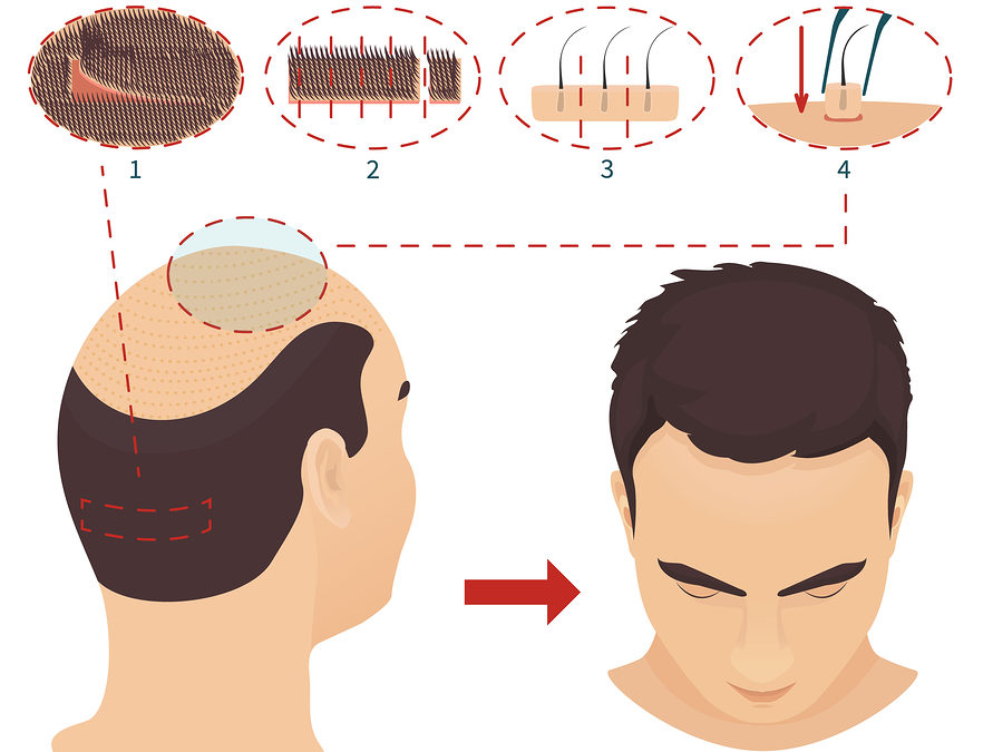 FUT Haartransplantation Methode