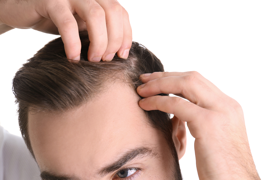 Glatze – Männer, Haarverlust & Geheimratsecken