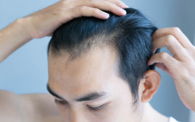 5 Gründe für eine Haartransplantation bei irreversiblem Haarschwund