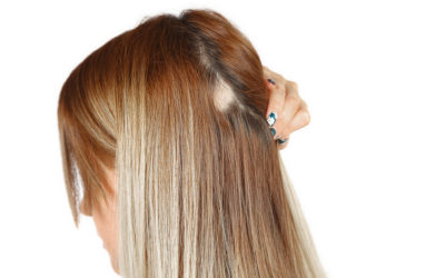 Haarausfall Frauen – Mittel gegen diffusen & erblich bedingten Haarverlust