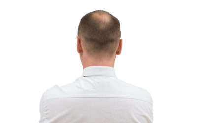 Haarausfall Männer – Ursachen