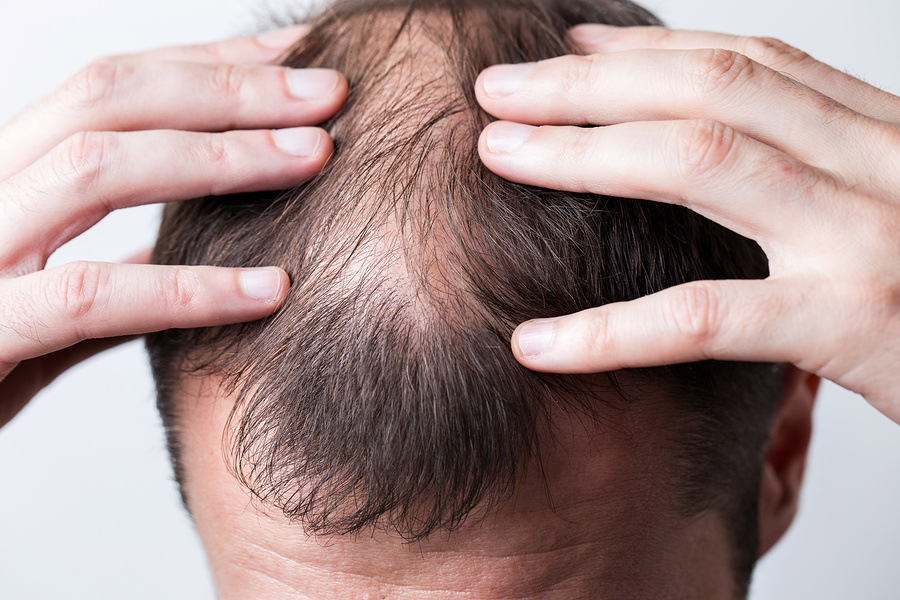 Haarausfall durch Kopfhauterkrankungen vorbeugen und behandeln