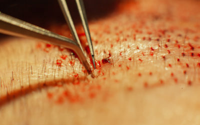 Haarimplantation: Methoden, Erfahrungen und Kosten