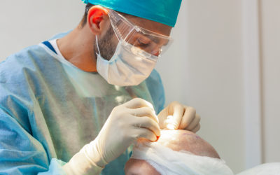 Haartransplantation – Behandlung und die Alternativen