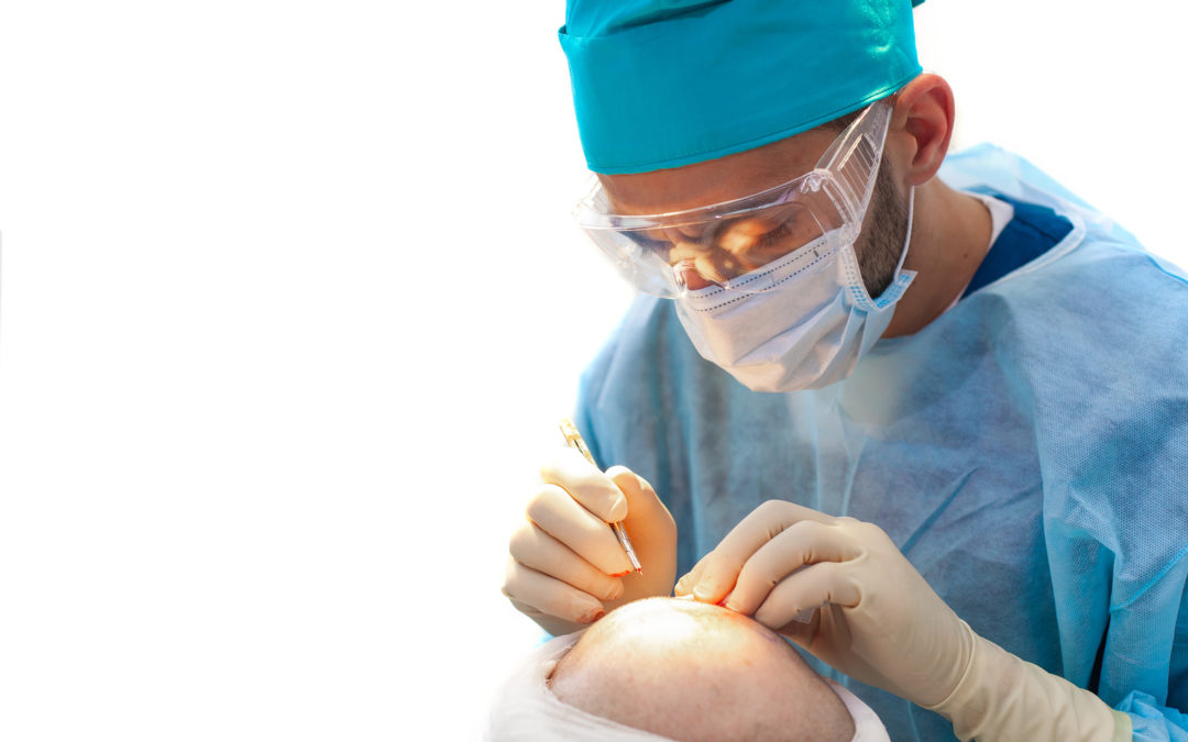 Haartransplantation bei einer Tonsur - innovative Methode sorgt für hervorragende Ergebnisse