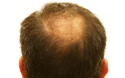 Haarverlust – Was tun gegen Haarausfall