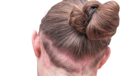Ist Haarausfall bei Neurodermitis möglich?