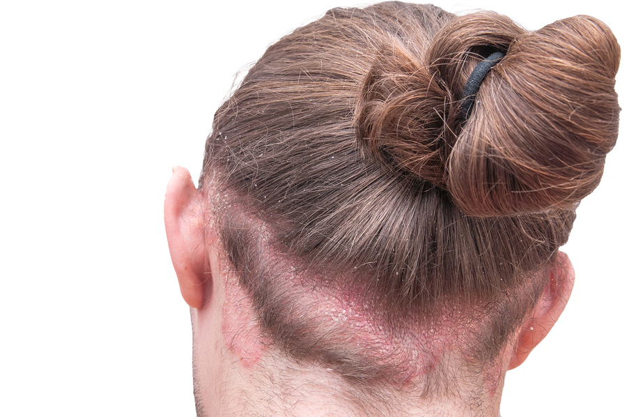 Ist Haarausfall bei Neurodermitis möglich