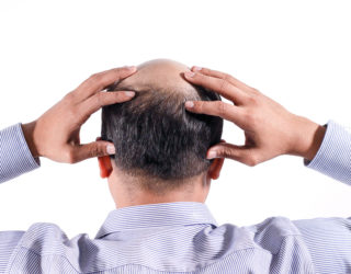 Kreisrunder Haarausfall Was Ist Kreisrunder Haarausfall Kreisrunder Haarausfall Was Ist Kreisrunder Haarausfall