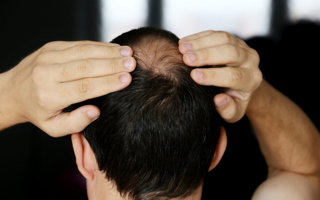 Lichen planopilaris Eine Form von vernarbendem Haarausfall