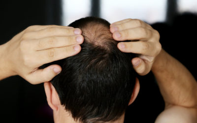 Lichen planopilaris: Eine Form von vernarbendem Haarausfall