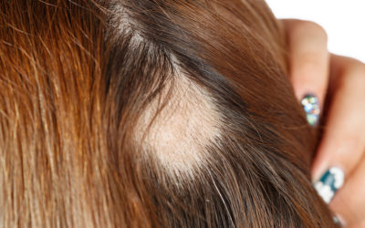 Mittel gegen Haarausfall Frau