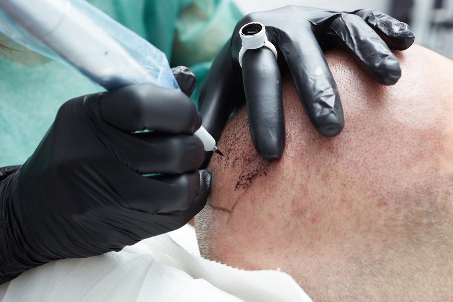 Nanohaarpigmentierung – optisch volles Haar ohne Operation