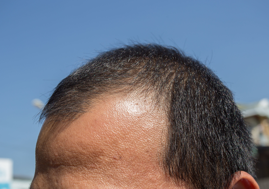 Neuer Therapieansatz Stromreize gegen Haarausfall