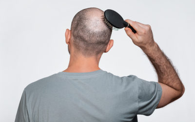 Reiztherapie bei kreisrundem Haarausfall