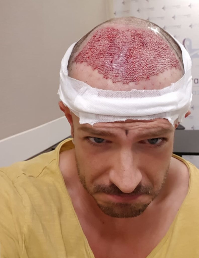 Tag der Haartransplantation in der Türkei