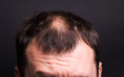 Trichorrhexis nodosa: Wenn die Haarstruktur geschädigt ist