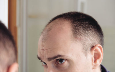 Was macht einen krankhaften Haarausfall aus?