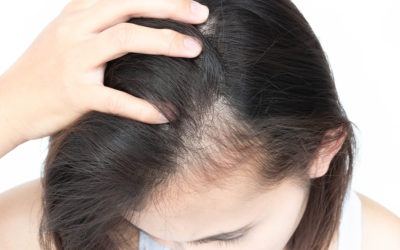 Weshalb entsteht Haarausfall am Haaransatz?