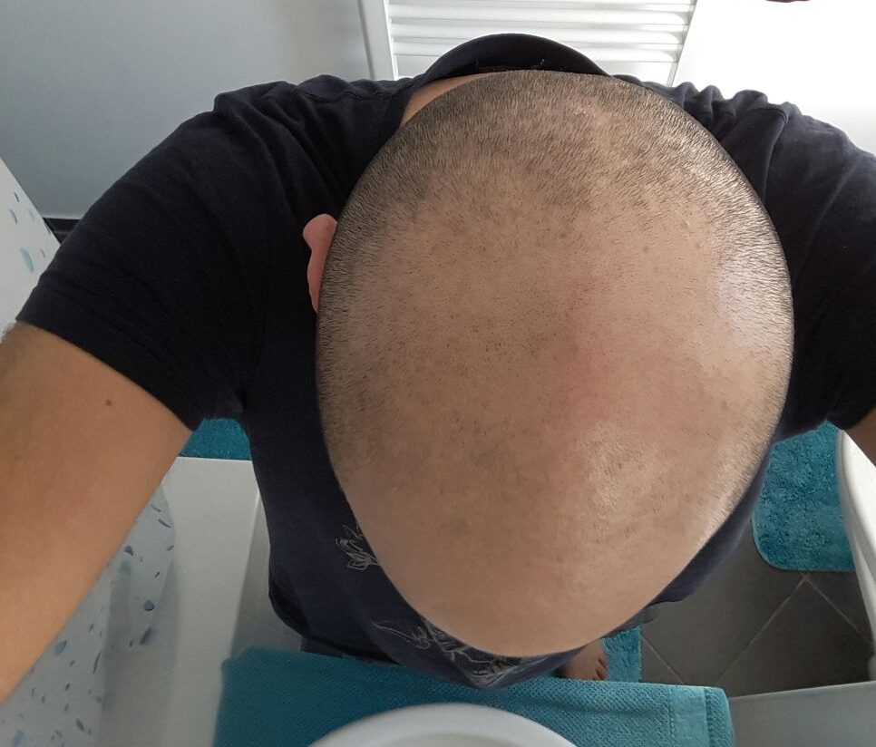 Mann ohne Haare vor der Behandlung bei Dr. Pigment von oben