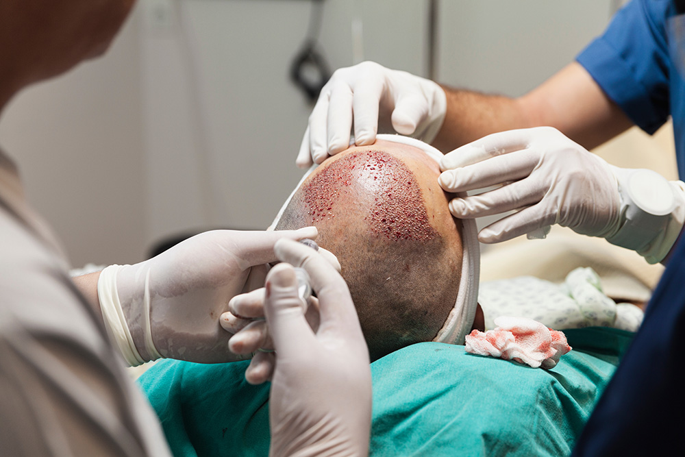 Zweite Haartransplantation – möglich und sinnvoll?