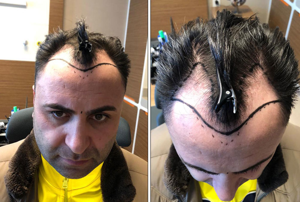 Meine Haartransplantation Istanbul Erfahrungen