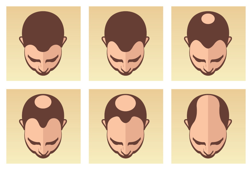 Stadien des erblichen Haarausfalls bei Männern