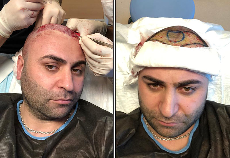 waehrend haartransplantation erfahrung murat